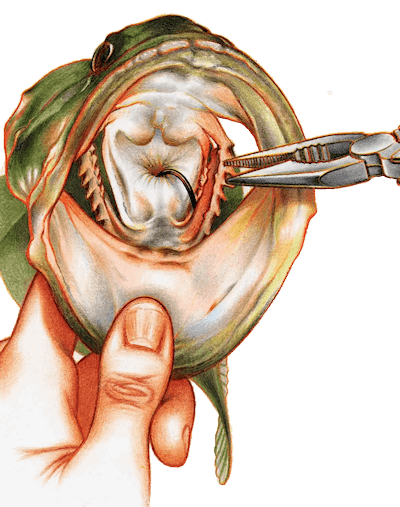 removing deeply lodged hook